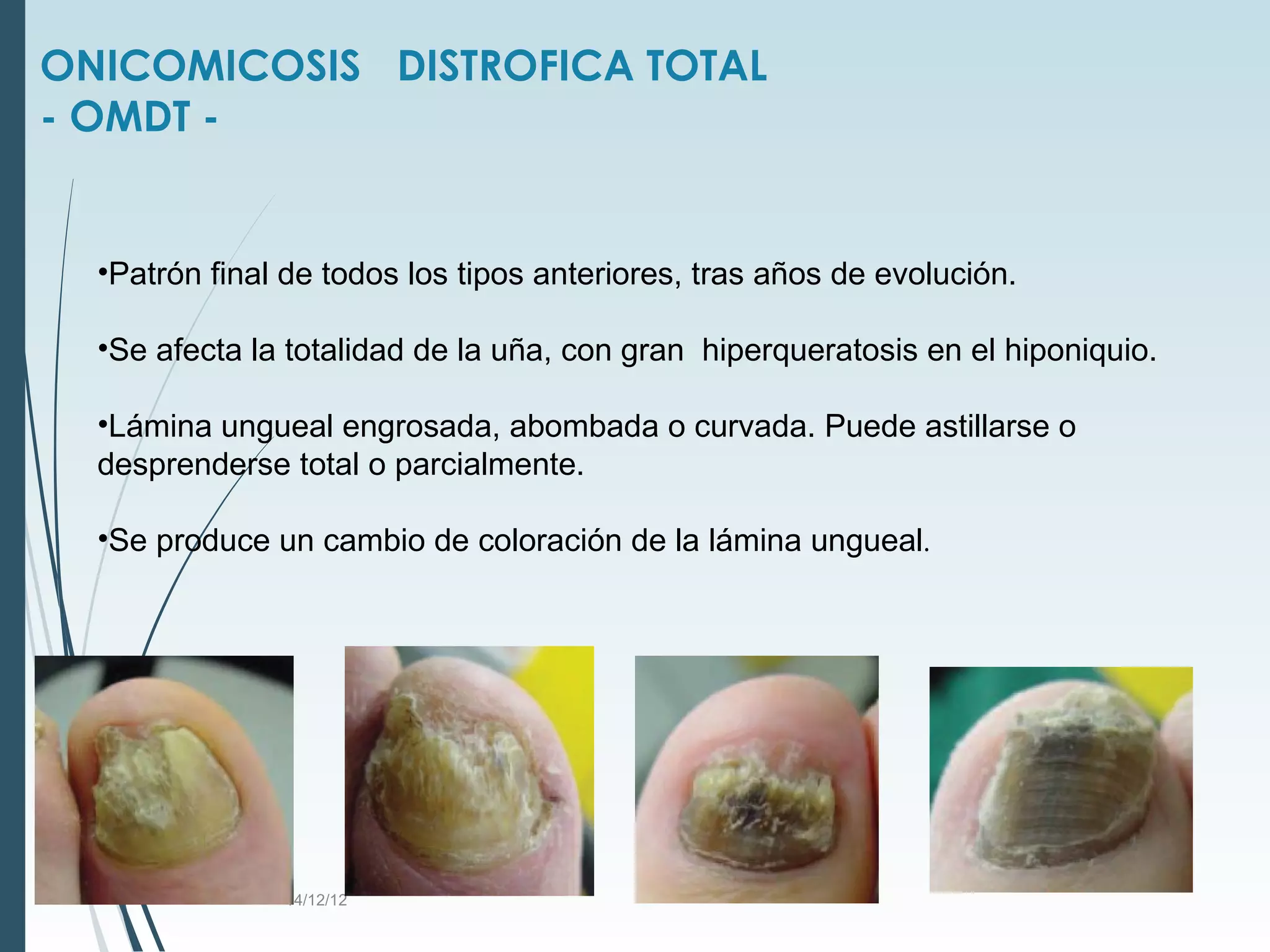 Onicomicosis, tipos, agentes infecciosos, tratamientos. | PPT