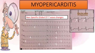 MYOPERICARDITIS
Non Specific Global ST-T wave changes
 