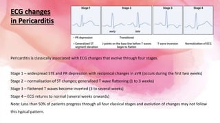 ECG changes
in Pericarditis
Pericarditis is classically associated with ECG changes that evolve through four stages.
Stage 1 – widespread STE and PR depression with reciprocal changes in aVR (occurs during the first two weeks)
Stage 2 – normalisation of ST changes; generalised T wave flattening (1 to 3 weeks)
Stage 3 – flattened T waves become inverted (3 to several weeks)
Stage 4 – ECG returns to normal (several weeks onwards)
Note: Less than 50% of patients progress through all four classical stages and evolution of changes may not follow
this typical pattern.
 