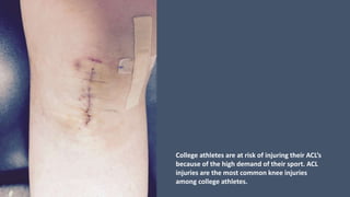 College athletes are at risk of injuring their ACL’s
because of the high demand of their sport. ACL
injuries are the most common knee injuries
among college athletes.
 