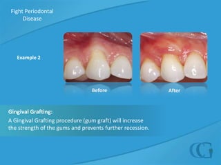  Hormonal changes (during puberty, pregnancy, and menopause, for example)Reduce your risk of periodontal disease by taking proper care of your teeth and  gums every day.