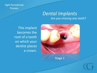 Did you know?Being diagnosed with periodontal disease often comes as a surprise to many people. It is usually not painful and it can only be detected by a trained eye. It progresses slowly, and you may not be aware of it until the advanced stages, such as severe swelling.