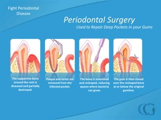 Fight Periodontal Disease  Deep Pocket Treatment OptionsDeep pockets that form in your gums can put you at risk of developing more severe periodontal disease.  Dr. Galler provides a number of treatment options aimed to restore unhealthy gums:  Deep Cleaning treatments for smaller pockets