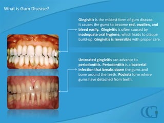 What is Gum Disease?Gingivitis is the mildest form of gum disease.  It causes the gums to become red, swollen, and bleed easily.  Gingivitis is often caused by inadequate oral hygiene, which leads to plaque build-up. Gingivitis is reversible with proper care.Untreated gingivitis can advance to periodontitis. Periodontitisis a bacterial infection that breaks down the gums and bone around the teeth. Pockets form where gums have detached from teeth.