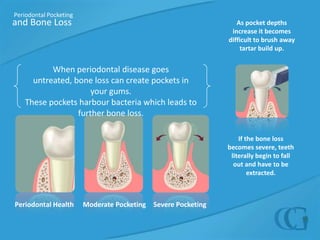 Periodontal Pocketingand Bone LossAs pocket depths increase it becomes difficult to brush away tartar build up.When periodontal disease goes untreated, bone loss can create pockets in your gums. These pockets harbour bacteria which leads to further bone loss.  If the bone loss becomes severe, teeth literally begin to fall out and have to be extracted.Periodontal HealthModerate PocketingSevere Pocketing