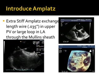 Extra Stiff Amplatz exchange length wire (.035”) in upper PV or large loop in LA  through the Mullins sheath 
