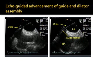 Coils Coils Guide Marker LA RA 
