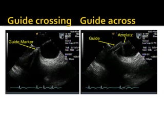 Guide Marker Amplatz Guide 