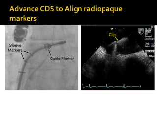 Clip Guide Marker Sleeve Markers 