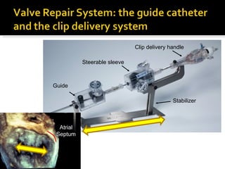 Guide Steerable sleeve Clip delivery handle Stabilizer Atrial Septum 