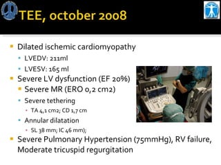 Dilated ischemic cardiomyopathy LVEDV: 211ml LVESV: 165 ml Severe LV dysfunction (EF 20%) Severe MR ( ERO 0,2 cm2) Severe tethering TA  4,1 cm2; CD 1,7 cm Annular dilatation SL 38 mm; IC 46 mm);  Severe Pulmonary Hypertension (75mmHg), RV failure, Moderate tricuspid regurgitation  