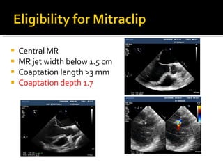 Central MR MR jet width below 1.5 cm Coaptation length >3 mm Coaptation depth 1.7  