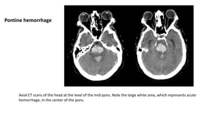 Axial CT scans of the head at the level of the mid-pons. Note the large white area, which represents acute
hemorrhage, in the center of the pons.
Pontine hemorrhage
 