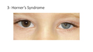 3- Horner’s Syndrome
 