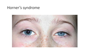 Horner’s syndrome
 