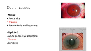 Ocular causes
-Miosis
• Acute Iritis
• Trauma
• Paracentesis and hypotony
-Mydriasis
. Acute congestive glaucoma
. Trauma
. Blind eye
 