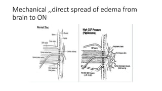 Mechanical ,,direct spread of edema from
brain to ON
 
