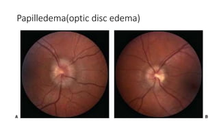Papilledema(optic disc edema)
 