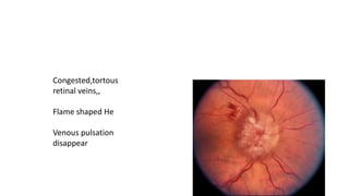 Congested,tortous
retinal veins,,
Flame shaped He
Venous pulsation
disappear
 