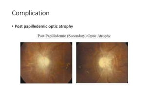 Complication
• Post papilledemic optic atrophy
 