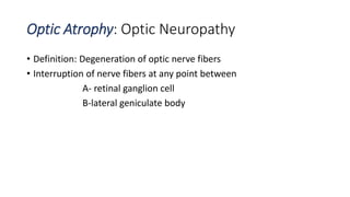 Optic Atrophy: Optic Neuropathy
• Definition: Degeneration of optic nerve fibers
• Interruption of nerve fibers at any point between
A- retinal ganglion cell
B-lateral geniculate body
 