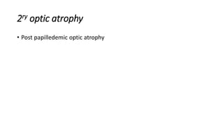 2ry optic atrophy
• Post papilledemic optic atrophy
 