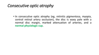 Consecutive optic atrophy
• In consecutive optic atrophy (eg, retinitis pigmentosa, myopia,
central retinal artery occlusion), the disc is waxy pale with a
normal disc margin, marked attenuation of arteries, and a
normal physiologic cup.
 
