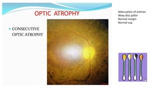 Attenuation of arteries
Waxy disc pallor
Normal margin
Normal cup
 