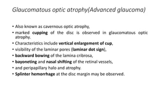 Glaucomatous optic atrophy(Advanced glaucoma)
• Also known as cavernous optic atrophy,
• marked cupping of the disc is observed in glaucomatous optic
atrophy.
• Characteristics include vertical enlargement of cup,
• visibility of the laminar pores (laminar dot sign),
• backward bowing of the lamina cribrosa,
• bayoneting and nasal shifting of the retinal vessels,
• and peripapillary halo and atrophy.
• Splinter hemorrhage at the disc margin may be observed.
 
