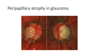 Peripapillary atrophy in glaucoma.
 