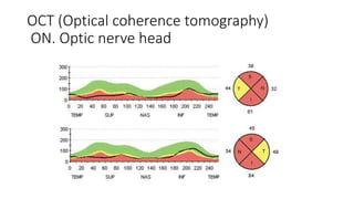 OCT (Optical coherence tomography)
ON. Optic nerve head
 
