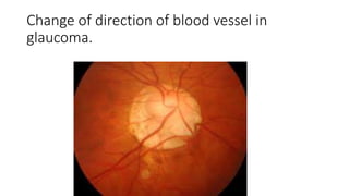 Change of direction of blood vessel in
glaucoma.
 