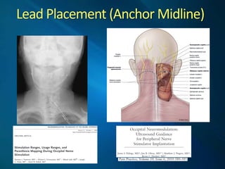Lead  Placement  (Anchor  Midline)  
 