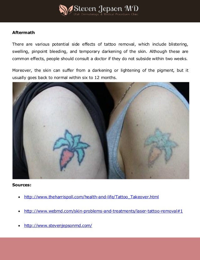 Sandpaper Tattoo Removal | on tattoos and tattoo removal Sandpaper Tattoo Removal | on tattoos and tattoo removal
