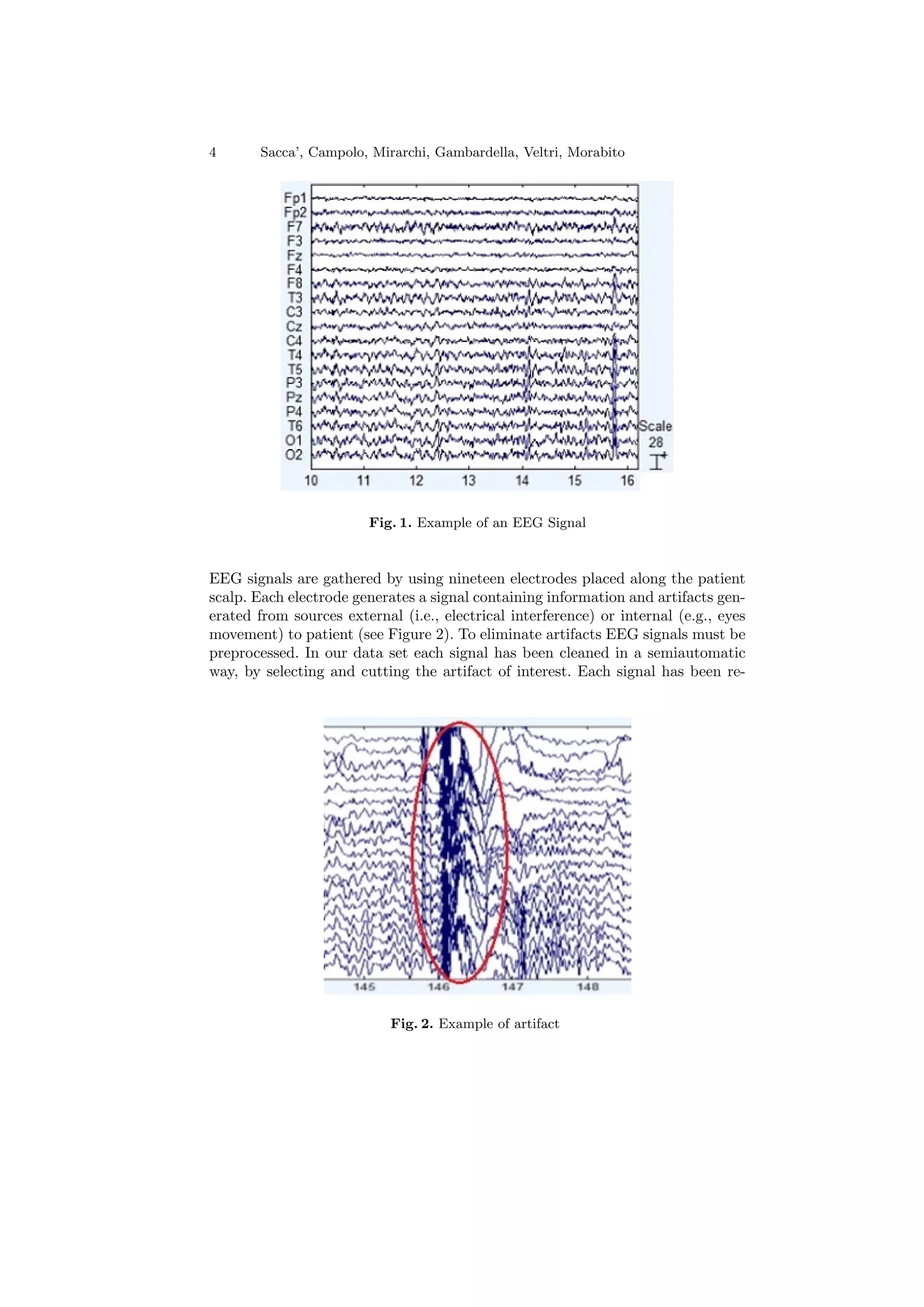 4 Sacca’, Campolo, Mirarchi, Gambardella, Veltri, Morabito
Fig. 1. Example of an EEG Signal
EEG signals are gathered by using nineteen electrodes placed along the patient
scalp. Each electrode generates a signal containing information and artifacts gen-
erated from sources external (i.e., electrical interference) or internal (e.g., eyes
movement) to patient (see Figure 2). To eliminate artifacts EEG signals must be
preprocessed. In our data set each signal has been cleaned in a semiautomatic
way, by selecting and cutting the artifact of interest. Each signal has been re-
Fig. 2. Example of artifact
 
