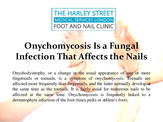 Onychomycosis Is a Fungal
Infection That Affects the Nails
Onychodystrophy, or a change in the usual appearance of one or more
fingernails or toenails, is a symptom of onychomycosis. Toenails are
affected more frequently than fingernails, and the latter normally develop at
the same time as the toenails. It is fairly usual for numerous nails to be
affected at the same time. Onychomycosis is frequently linked to a
dermatophyte infection of the foot (tinea pedis or athlete's foot).
 