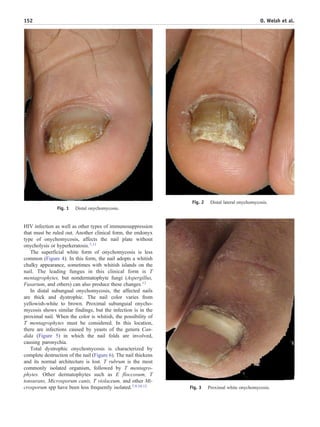 The Nail in Dermatological Diseases
