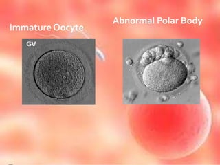 Abnormal Polar Body
Immature Oocyte
 