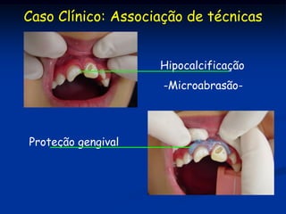 Caso Clínico: Associação de técnicas


                    Hipocalcificação
                     -Microabrasão-




Proteção gengival
 