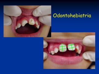 Odontohebiatria
 