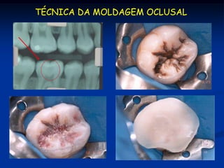 TÉCNICA DA MOLDAGEM OCLUSAL
 
