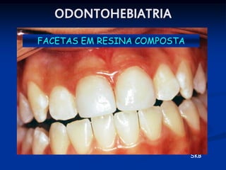 ODONTOHEBIATRIA
FACETAS EM RESINA COMPOSTA




                             SKB
 