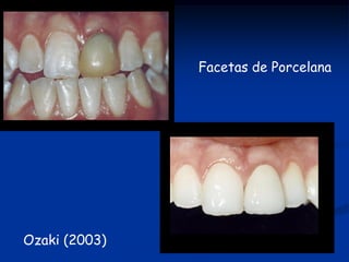 Facetas de Porcelana




Ozaki (2003)
 