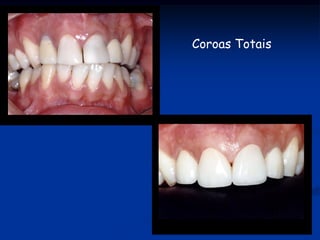 Coroas Totais
 