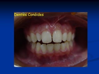 Dentes Conóides
 