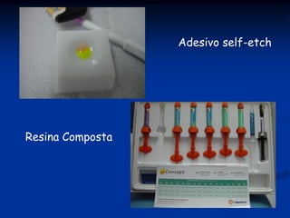 Adesivo self-etch




Resina Composta
 