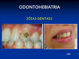ODONTOHEBIATRIA

  JÓIAS DENTAIS




                  SKB
 