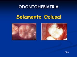 ODONTOHEBIATRIA

Selamento Oclusal




                    SKB
 