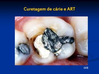 Curetagem de cárie e ART




                           SKB
 