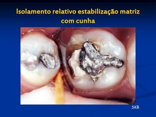 Isolamento relativo estabilização matriz
              com cunha




                                     SKB
 